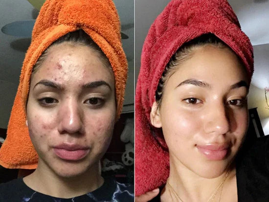 Elaria Rice Peel Serum Ampoule™